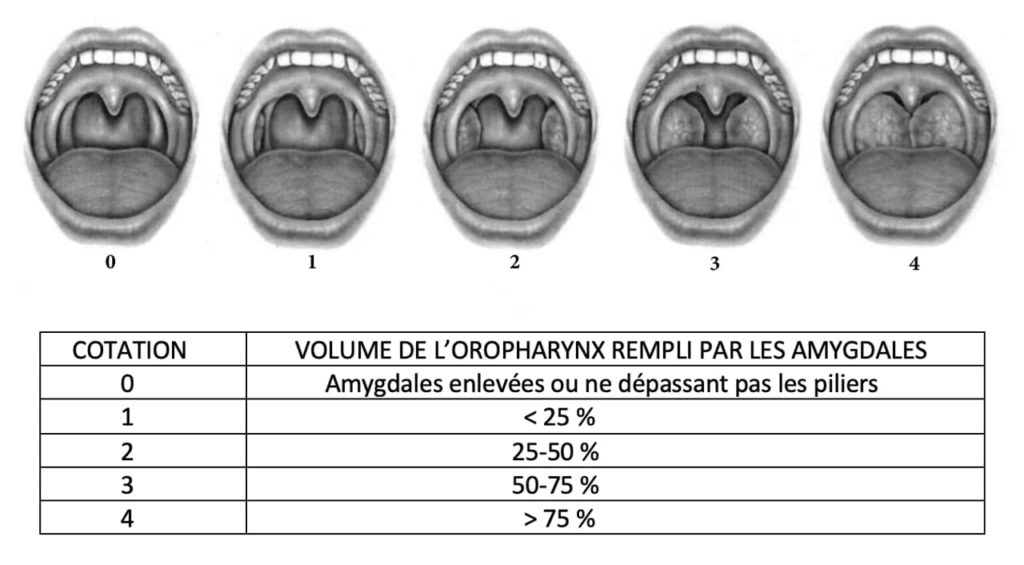 Amygdalectomie ou chirurgie des amygdales | indications, risques ...