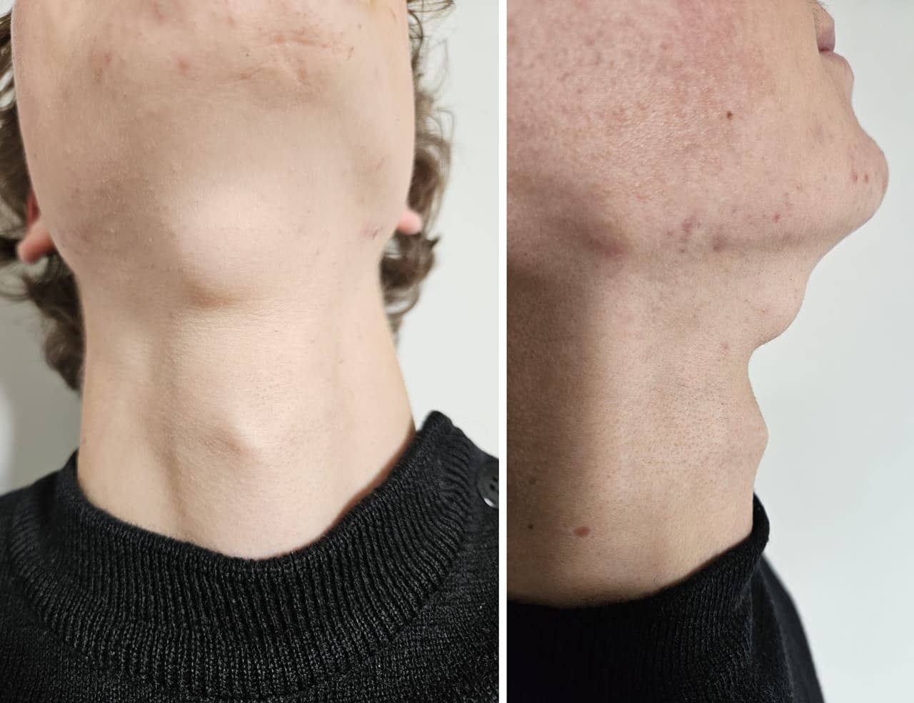 Kyste dermoïde du plancher buccal - vue de face et de profil